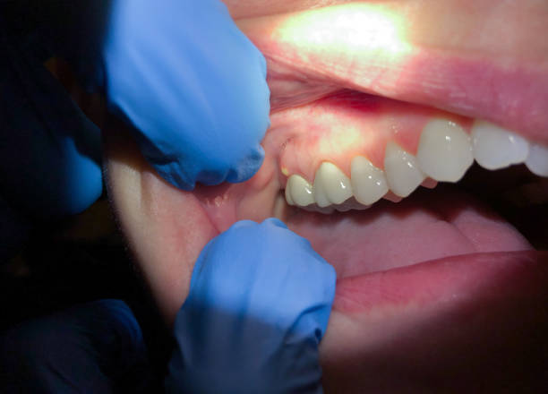 Best Emergency Tooth Extraction in Estherville, IA