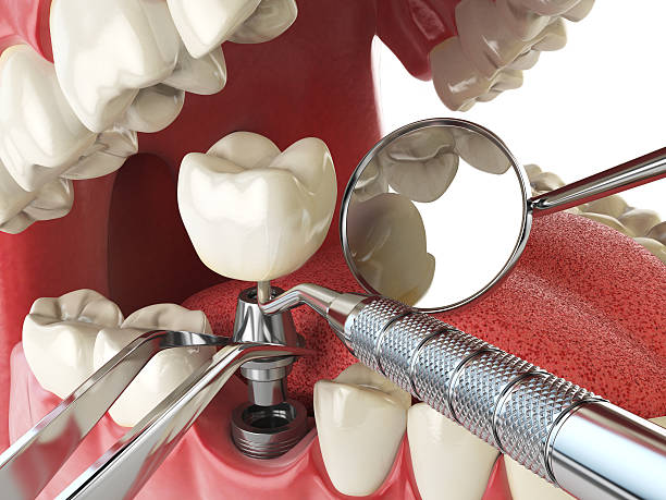 Best Emergency Denture Repair in Estherville, IA
